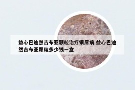 益心巴迪然吉布亚颗粒治疗银屑病 益心巴迪然吉布亚颗粒多少钱一盒