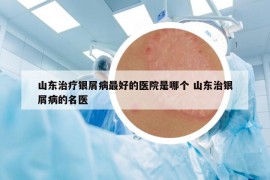 山东治疗银屑病最好的医院是哪个 山东治银屑病的名医