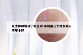 凡士林和裂可宁的区别 手裂用凡士林和裂可宁哪个好
