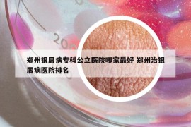 郑州银屑病专科公立医院哪家最好 郑州治银屑病医院排名