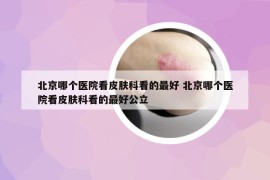北京哪个医院看皮肤科看的最好 北京哪个医院看皮肤科看的最好公立