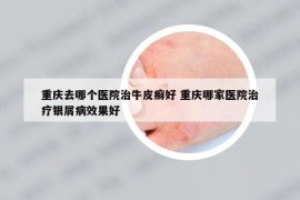 重庆去哪个医院治牛皮癣好 重庆哪家医院治疗银屑病效果好