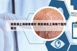 银屑病上海哪里看好 银屑病去上海哪个医院看好