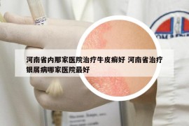 河南省内那家医院治疗牛皮癣好 河南省治疗银屑病哪家医院最好