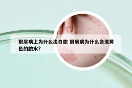银屑病上为什么出白脓 银屑病为什么会流黄色的脓水?