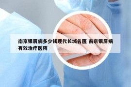 南京银屑病多少钱现代长城名医 南京银屑病有效治疗医院