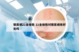 银屑病21金维他 21金维他对银屑病有好处吗