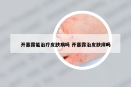 开塞露能治疗皮肤病吗 开塞露治皮肤痒吗