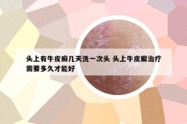 头上有牛皮癣几天洗一次头 头上牛皮廨治疗需要多久才能好