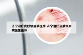 济宁治疗皮肤银屑病医生 济宁治疗皮肤银屑病医生推荐
