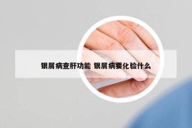 银屑病查肝功能 银屑病要化验什么