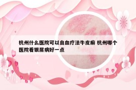杭州什么医院可以自血疗法牛皮癣 杭州哪个医院看银屑病好一点