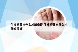 牛皮癣要吃什么才能吃得 牛皮癣要吃什么才能吃得好