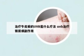 治疗牛皮癣的UVB是什么疗法 uvb治疗银屑病副作用