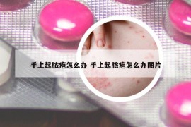 手上起脓疱怎么办 手上起脓疱怎么办图片
