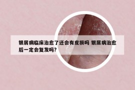 银屑病临床治愈了还会有皮损吗 银屑病治愈后一定会复发吗?