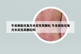 牛皮癣能吃复方木尼孜其颗粒 牛皮癣能吃复方木尼孜其颗粒吗