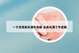 一个月浑身长满牛皮癣 全身长满了牛皮癣