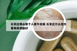 石家庄横山那个人看牛皮癣 石家庄什么地方看银屑病最好