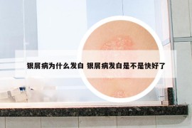 银屑病为什么发白 银屑病发白是不是快好了