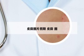 皮藓图片初期 皮藓 图