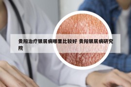 贵阳治疗银屑病哪里比较好 贵阳银屑病研究院