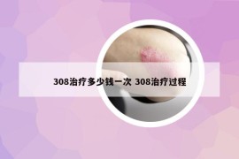 308治疗多少钱一次 308治疗过程