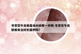 寻常型牛皮癣是体内缺那一种酶 寻常性牛皮肤癣有治好的案例吗?