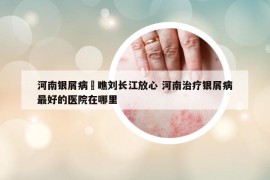 河南银屑病來瞧刘长江放心 河南治疗银屑病最好的医院在哪里