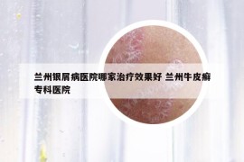 兰州银屑病医院哪家治疗效果好 兰州牛皮癣专科医院