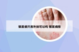 银屑病只用外抹可以吗 银屑病擦