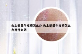头上都是牛皮癣怎么办 头上都是牛皮癣怎么办用什么药
