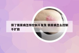 得了银屑病怎样控制不复发 银屑病怎么控制不扩散