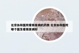 北京协和医院看银屑病的药物 北京协和医院哪个医生看银屑病好
