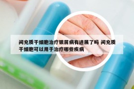 间充质干细胞治疗银屑病有进展了吗 间充质干细胞可以用于治疗哪些疾病