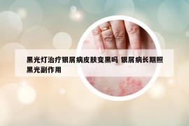 黑光灯治疗银屑病皮肤变黑吗 银屑病长期照黑光副作用