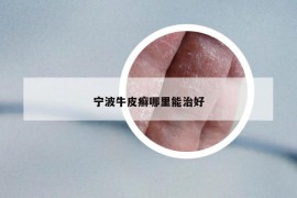 宁波牛皮癣哪里能治好