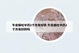 牛皮癣吃中药2个月有好转 牛皮癣吃中药2个月有好转吗