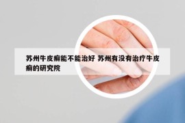 苏州牛皮癣能不能治好 苏州有没有治疗牛皮癣的研究院