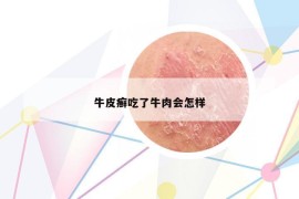 牛皮癣吃了牛肉会怎样