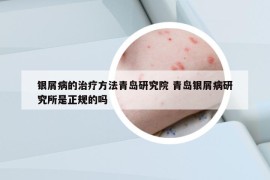 银屑病的治疗方法青岛研究院 青岛银屑病研究所是正规的吗