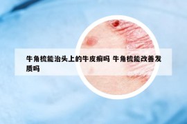 牛角梳能治头上的牛皮癣吗 牛角梳能改善发质吗