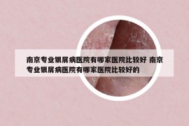 南京专业银屑病医院有哪家医院比较好 南京专业银屑病医院有哪家医院比较好的