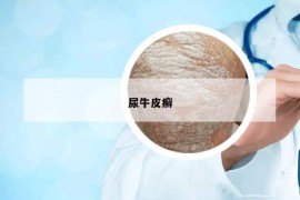 尿牛皮癣