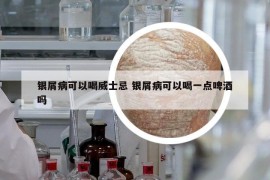 银屑病可以喝威士忌 银屑病可以喝一点啤酒吗