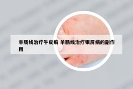 羊肠线治疗牛皮癣 羊肠线治疗银屑病的副作用