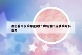 廊坊看牛皮癣哪医院好 廊坊治疗皮肤病专科医院