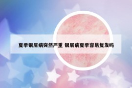 夏季银屑病突然严重 银屑病夏季容易复发吗