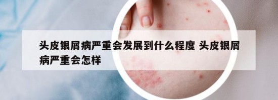 头皮银屑病严重会发展到什么程度 头皮银屑病严重会怎样