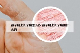 孩子腿上长了癣怎么办 孩子腿上长了癣用什么药